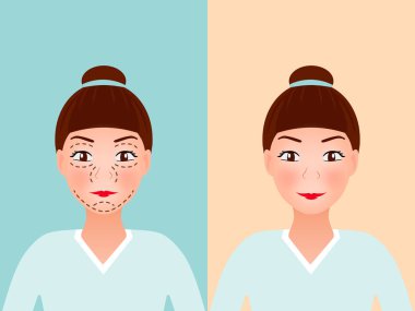 Genç güzel kadının yüz plastik cerrahi için delikli çizgiler çizim. Önce ve sonra yordamı. vektör çizim. tıbbi yüz Asansör anti-aging kavramı.