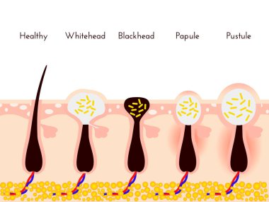 Skin problems. Types of acne pimples. Facial treatments and problem vector illustration. Whiteheads and Blackheads, Papules and Pustules clipart