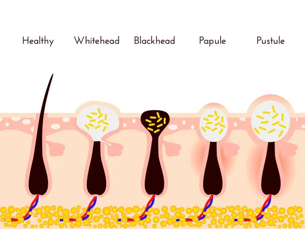 Problemas de pele. Tipos de espinhas de acne. Tratamentos faciais e ilustração do vetor problemático. Cabeças brancas e cravos, pápulas e pústulas — Vetor de Stock