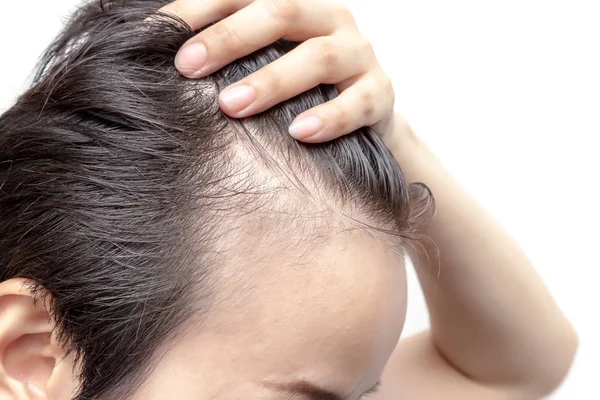 Bald man or woman worry about his or her less hairline — Stock Photo, Image