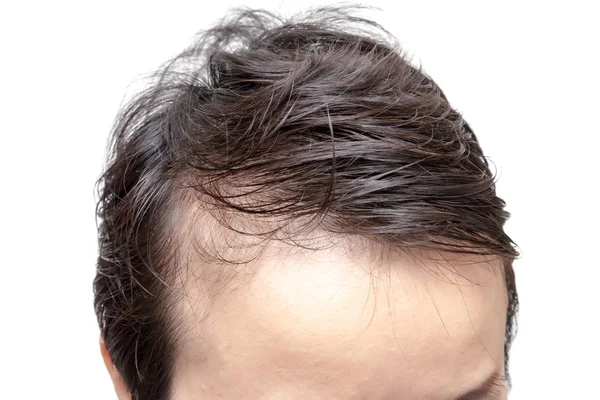 Mann oder Frau mit Glatze sorgen sich um weniger Haaransatz lizenzfreie Stockbilder