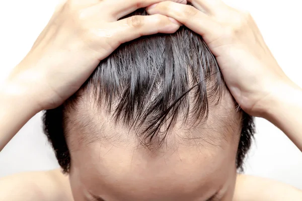 Mann oder Frau mit Glatze sorgen sich um weniger Haaransatz lizenzfreie Stockfotos