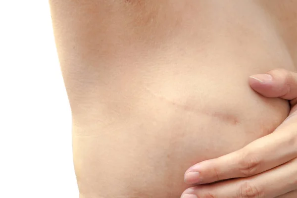 Cicatriz de la operación de cáncer de mama — Foto de Stock