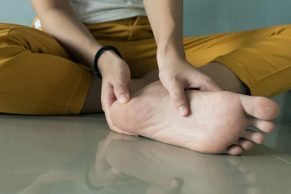 Close Peeling Cracked Foot Causes Peeling Foot Included Fungal Infection — Stock Photo, Image