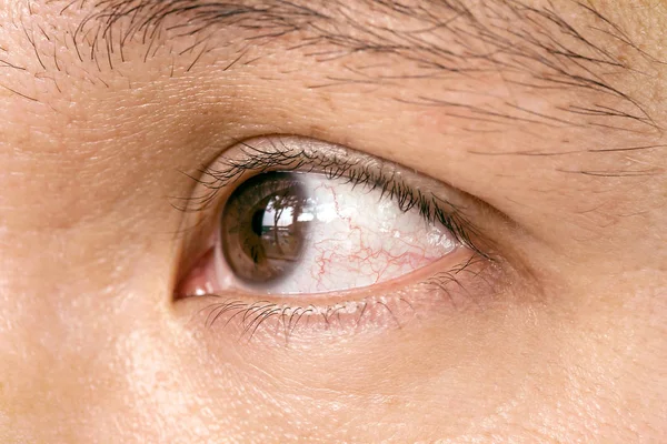결막염 눈동자 눈 — 스톡 사진