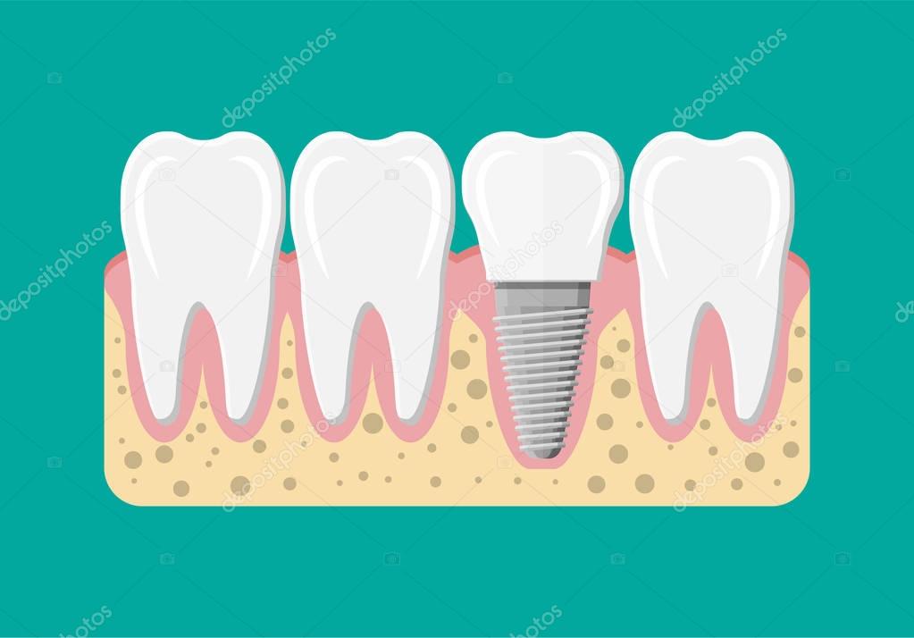 Tooth restoration. Dental implant. Dental prostheses. Artificial teeth with steel pin. Oral care, stomatology and dentistry. Vector illustration in flat style