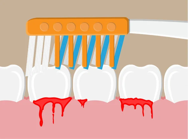 Enfermedad periodontal, encías sangrantes — Vector de stock