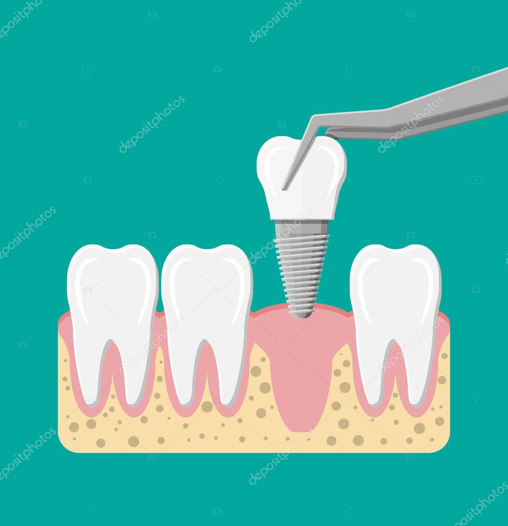 Tooth restoration. Installation of the dental implant. Dental prostheses. Artificial teeth with steel pin. Oral care, stomatology and dentistry. Vector illustration in flat style