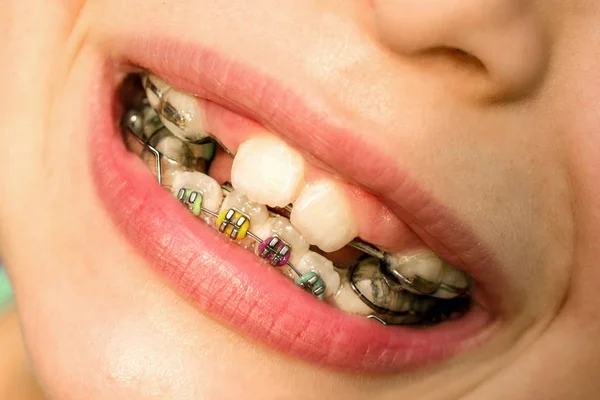 Metal braces in the child mouth. Dental care. Smile with ortodon