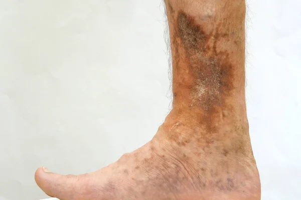 İnsan derisi hastalığı. Dermatolojiden etkilenen insan ayağı