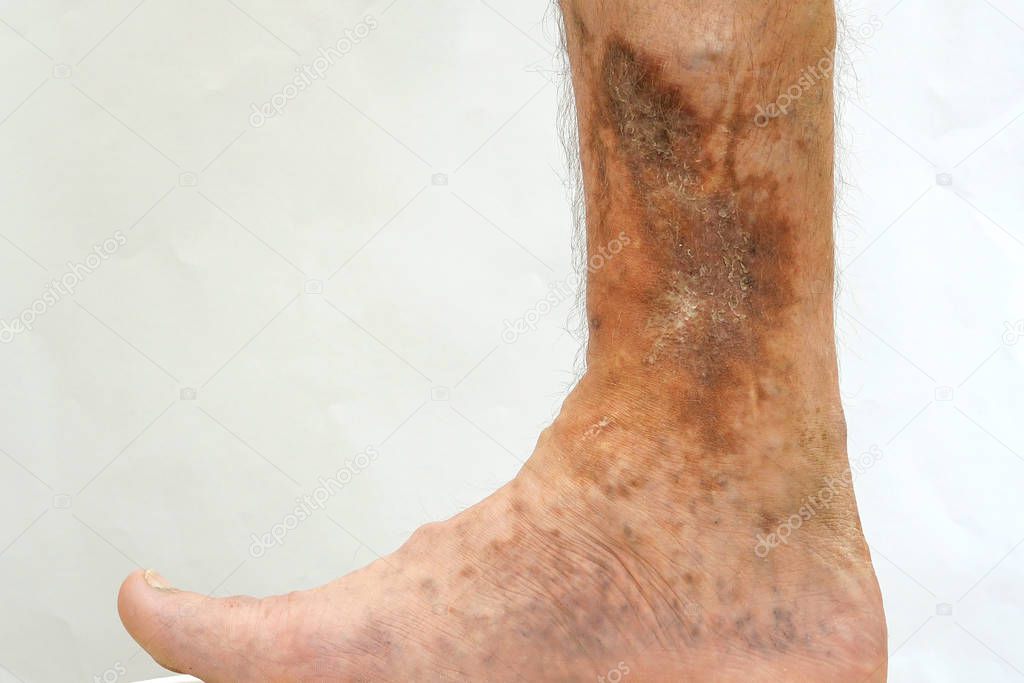 Human skin disease. Person s foot that is affected by dermatolog