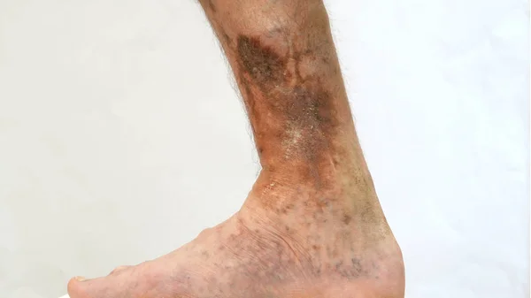 인간 피부 질환. 피부과에 걸려 있는 사람 의발 — 스톡 사진