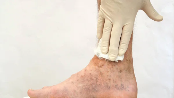 Doença da pele humana. Guardanapos sanitários em cicatrizes, úlceras, peelings — Fotografia de Stock