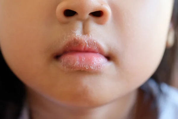 Close-up of mouth Asian girl with allergies, skin peeling and itching. — Stock Photo, Image