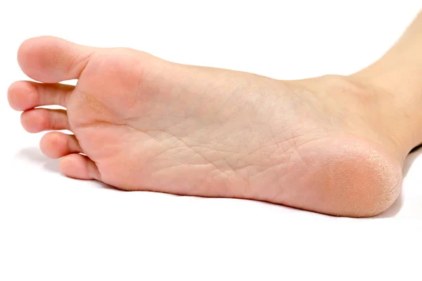 Женская Пятка Ноги Сухие Белом Фоне — стоковое фото