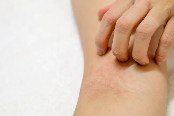 Vrouwen Handen Krabben Allergie Voor Rode Huiduitslag Witte Achtergrond — Stockfoto