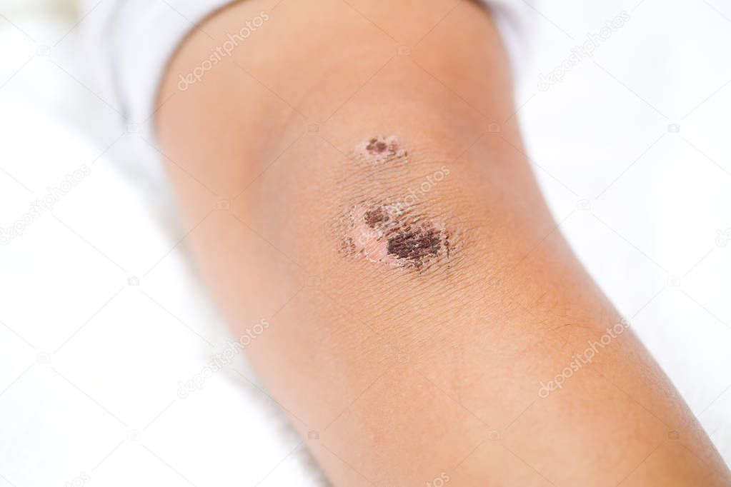wound scab of a child's knee on a white background