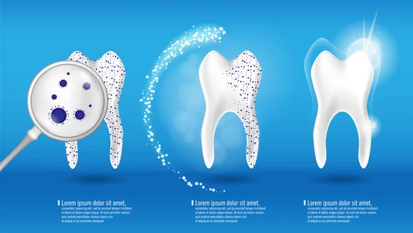 Santé dentaire Concept Ensemble vectoriel. Dent 3d réaliste brillant propre et sale sur fond bleu, processus de nettoyage et de blanchiment des dents. Soins buccodentaires, restauration des dents — Image vectorielle