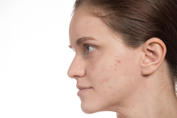 Menina bonita com acne vermelha e branca em seu rosto. Antes — Fotografia de Stock