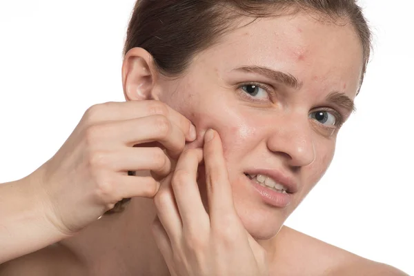 Yüzünde kırmızı ve beyaz sivilce ile güzel genç kız. Daha önce