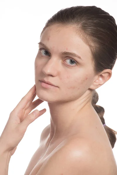 Mooi meisje met rode en witte acne op haar gezicht. Voordat — Stockfoto