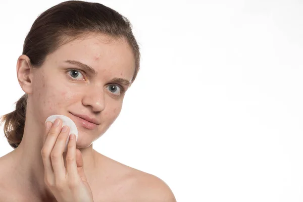 Belle jeune fille avec de l'acné rouge et blanche sur le visage. Avant — Photo