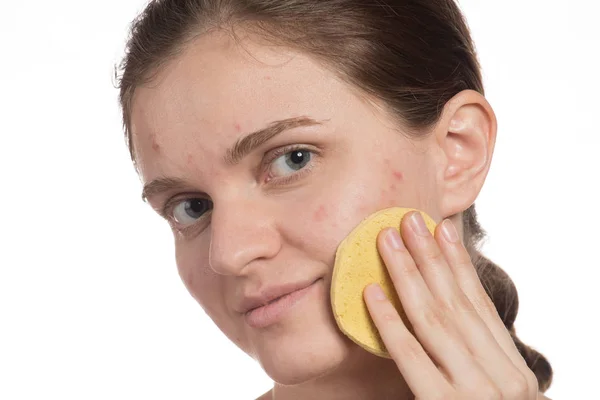 Beautiful young girl with red and white acne on her face. Before — Stock Photo, Image