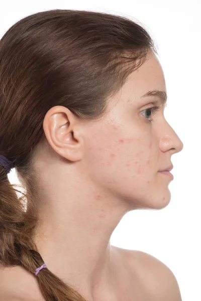 Krásná mladá dívka s červenými a bílými akné na tváři. Před — Stock fotografie