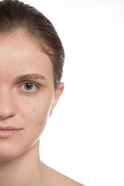Vacker ung flicka med röda och vita akne i ansiktet. Innan — Stockfoto