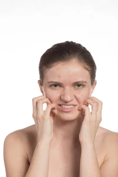 Beautiful young girl with red and white acne on her face. Before — Stock Photo, Image