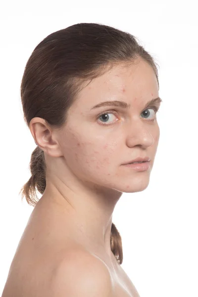 Smuk ung pige med rød og hvid acne i ansigtet. Før - Stock-foto
