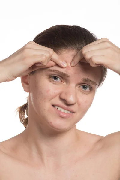 Beautiful young girl with red and white acne on her face. Before — Stock Photo, Image