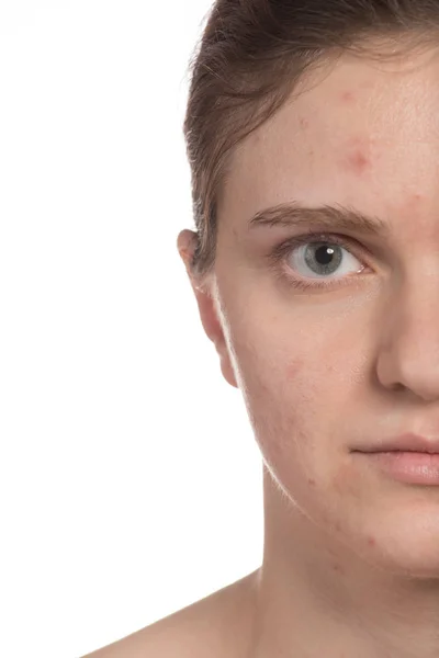 Menina bonita com acne vermelha e branca em seu rosto. Antes — Fotografia de Stock