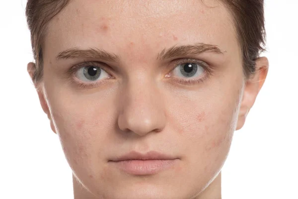 Beautiful young girl with red and white acne on her face. Before — Stock Photo, Image