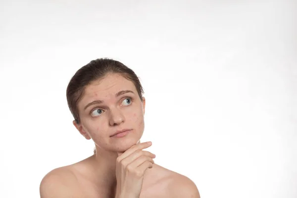 Hermosa joven con acné rojo y blanco en la cara. Antes. — Foto de Stock