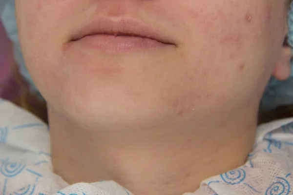 Nettoyage facial professionnel de l'acné dans la cabine — Photo