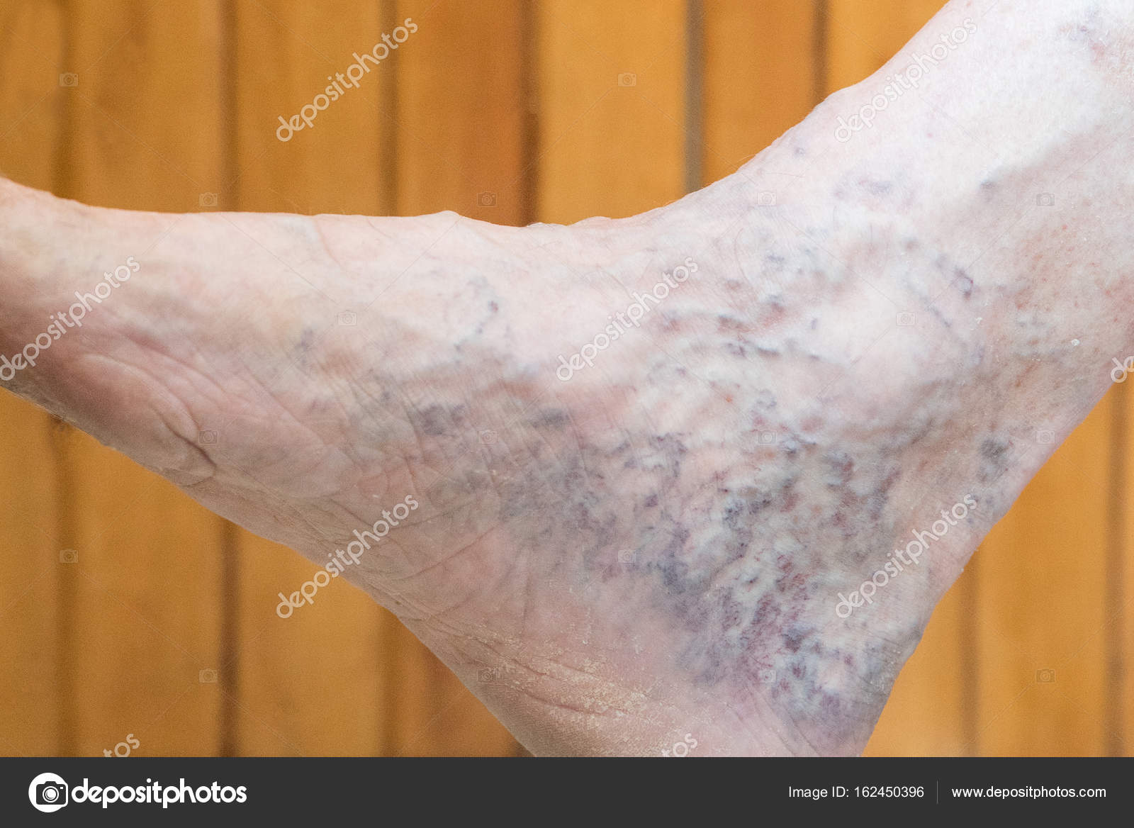 blue spot pe picior varicoza
