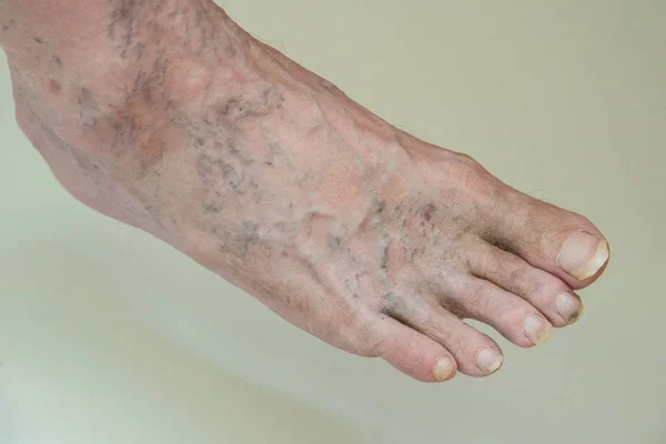The leg of an adult person looks painful because of swollen vein