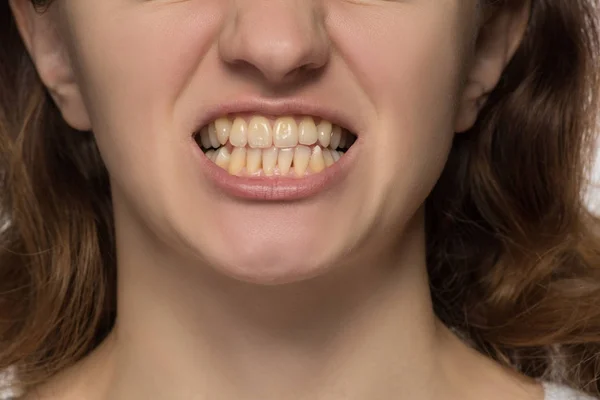 Žlutá není rovný a křivé zuby mladé ženy — Stock fotografie