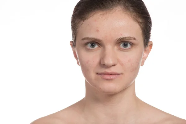 Beautiful girl with red and white acne on her face. Stop acne on — Stock Photo, Image