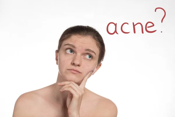 Hermosa chica con acné rojo y blanco en la cara. Detener el acné — Foto de Stock