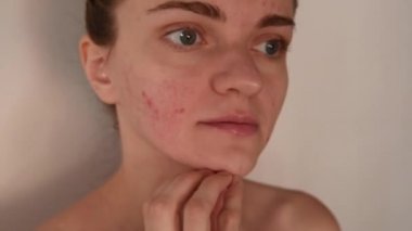 Güzel genç esmer kız darbeye ve çizikler beyaz ve kırmızı sivilce ve akne yüzünde beyaz bir arka plan üzerinde