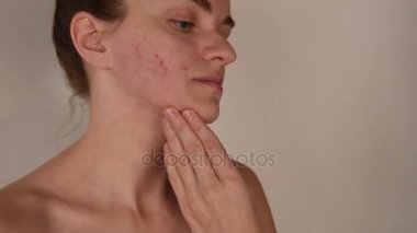 Güzel genç esmer kız darbeye ve çizikler beyaz ve kırmızı sivilce ve akne yüzünde beyaz bir arka plan üzerinde