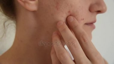 Güzel genç esmer kız darbeye ve çizikler beyaz ve kırmızı sivilce ve akne yüzünde beyaz bir arka plan üzerinde