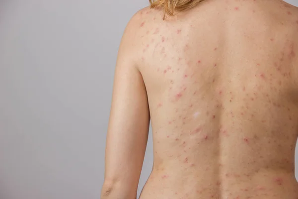 Mladá dívka s akné, s červenými skvrnami na zádech — Stock fotografie