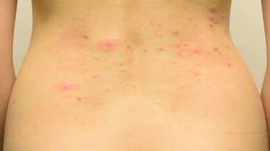 Bir genç kız o çizikler ve krema ile smear kırmızı ve beyaz sivilce ile arkası