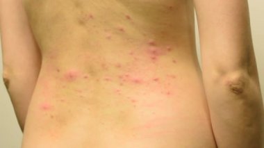 Bir genç kız o çizikler ve krema ile smear kırmızı ve beyaz sivilce ile arkası