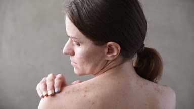 Sivilce ve akne arka ve yüz ile güzel genç esmer kız