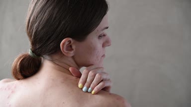 Sivilce ve akne arka ve yüz ile güzel genç esmer kız