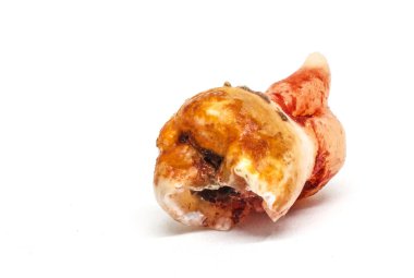 İzole bilgelik diş çürüğü.